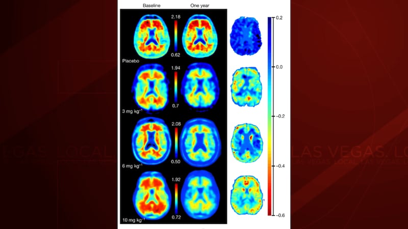 Scans of brains with Alzheimer's